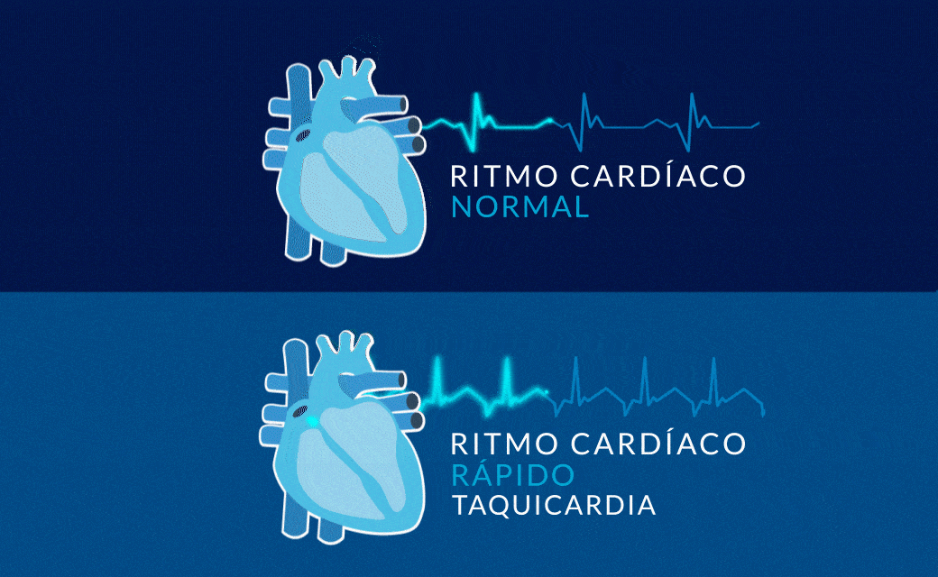 Ritmo Cardiaco Rápido Taquicardia